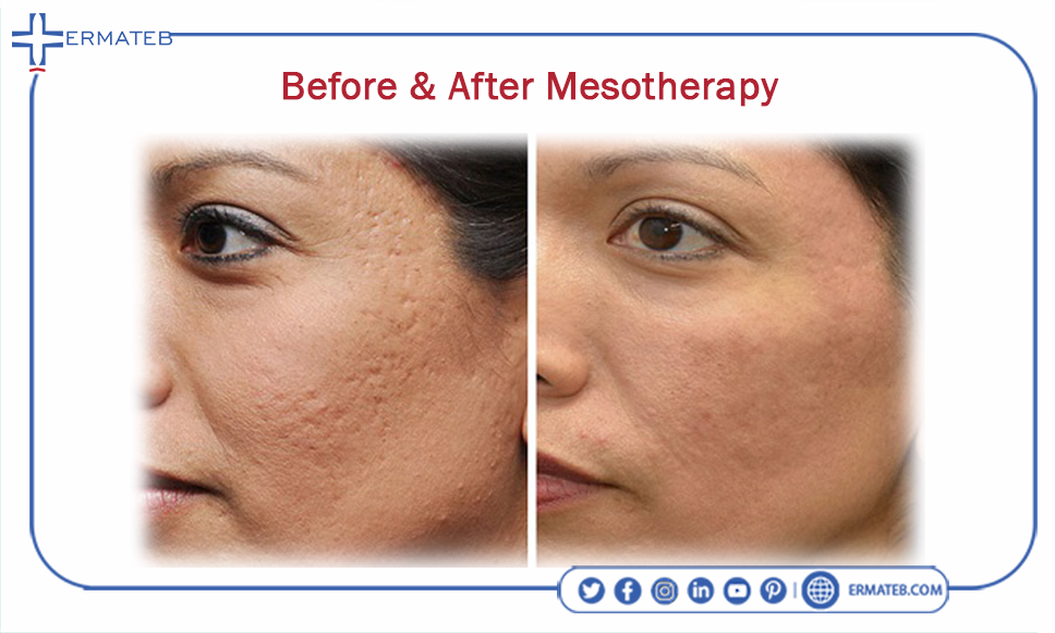 What Are Mesotherapy And Facial Mesotherapy 